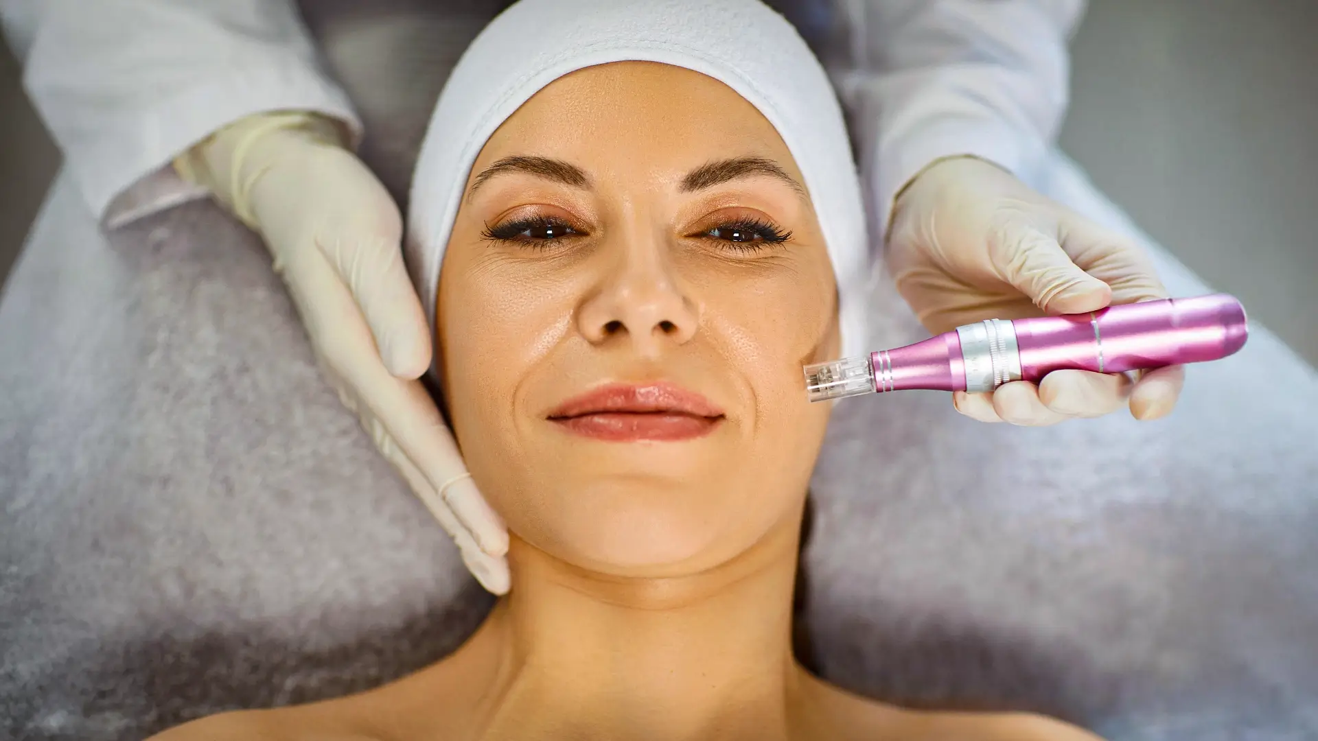 Professional microneedling treatment to rejuvenate skin texture – Beauty & Wellness clinic in New Westminster, BC